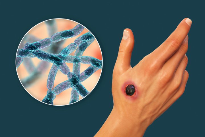 В Джизаке двух жителей госпитализировали с подозрением на сибирскую язву — видео