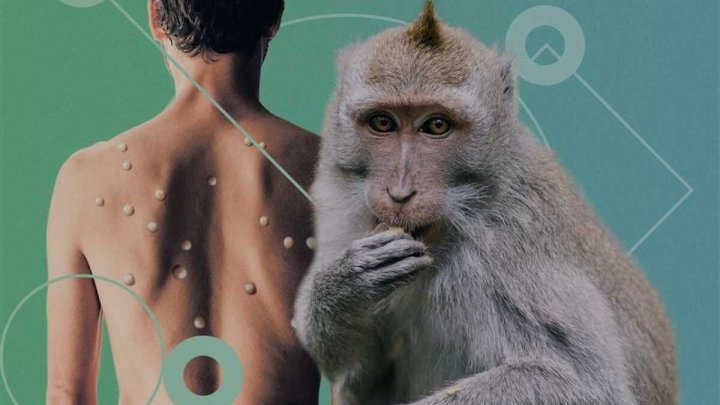 В Африке заболевание оспы выходит из под контроля эпидемиологов