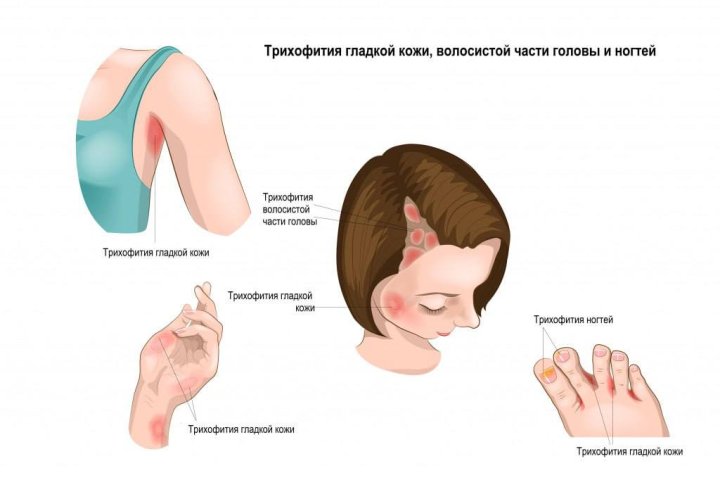 В СЭС прокомментировали слухи о вспышке трихофитии в Узбекистане