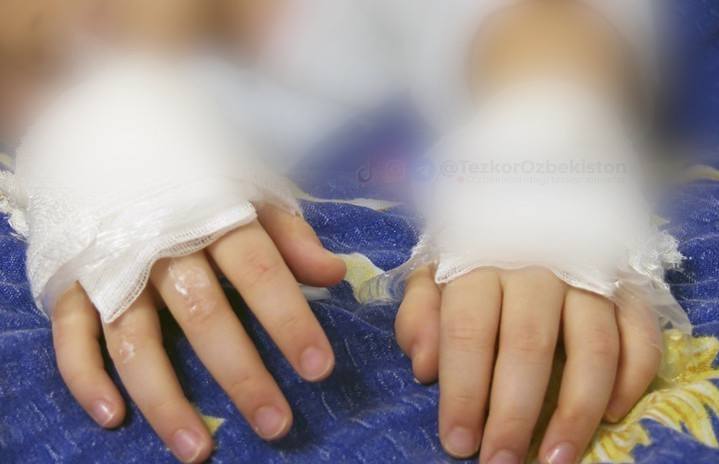 В Алмалыке женщина подожгла руки ребёнка в качестве наказания