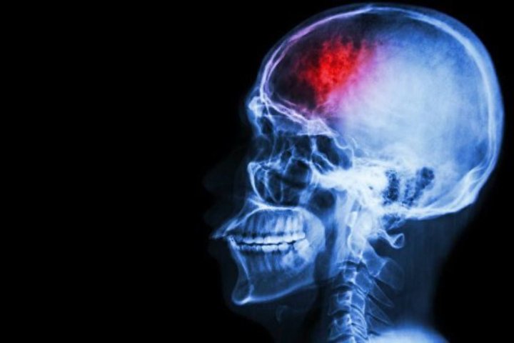 В Узбекистан вернули соотечественника, перенёсшего инсульт в Таиланде