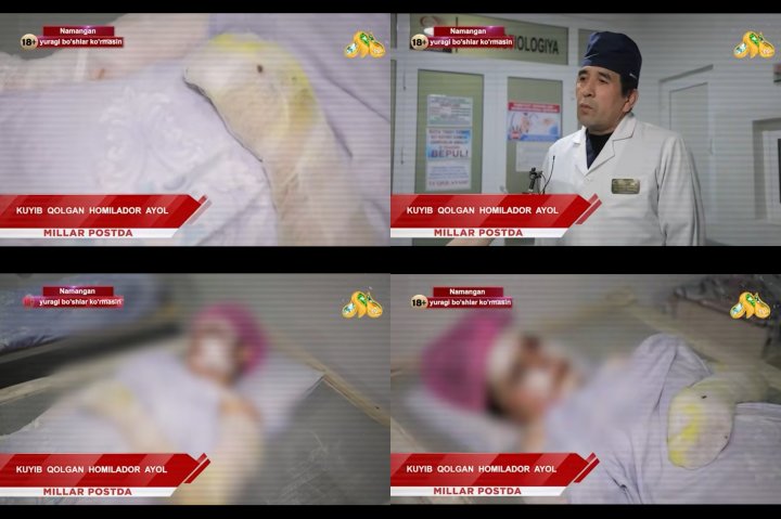 В Намангане беременная женщина серьёзно пострадала при взрыве газового баллона, но благополучно родила — видео