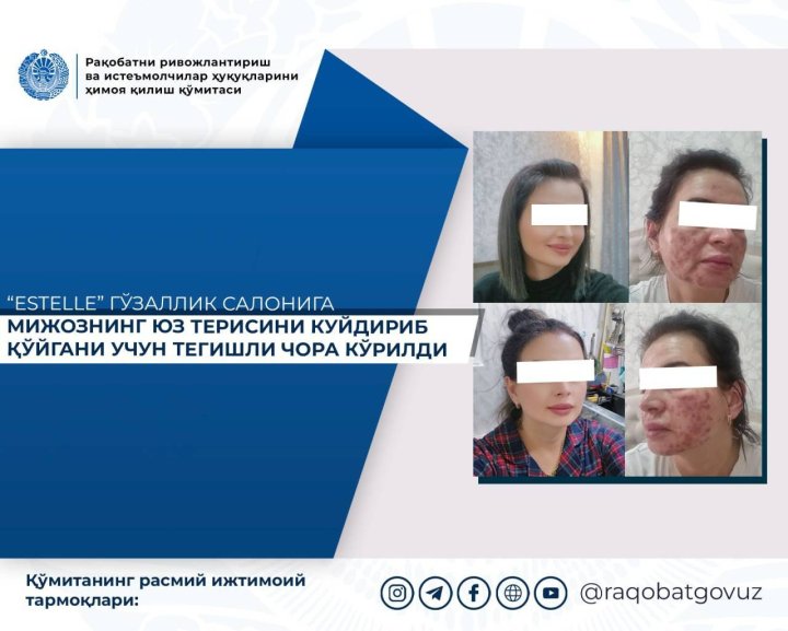 В Ташкенте в салоне красоты клиентке сожгли лицо