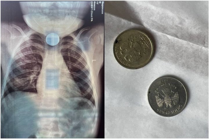 В Бухаре хирурги спасли жизнь двухлетнего ребёнка, проглотившего монеты