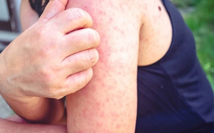 Chikungunya isitmasi odamlarni faol ravishda o‘ldirishni boshladi