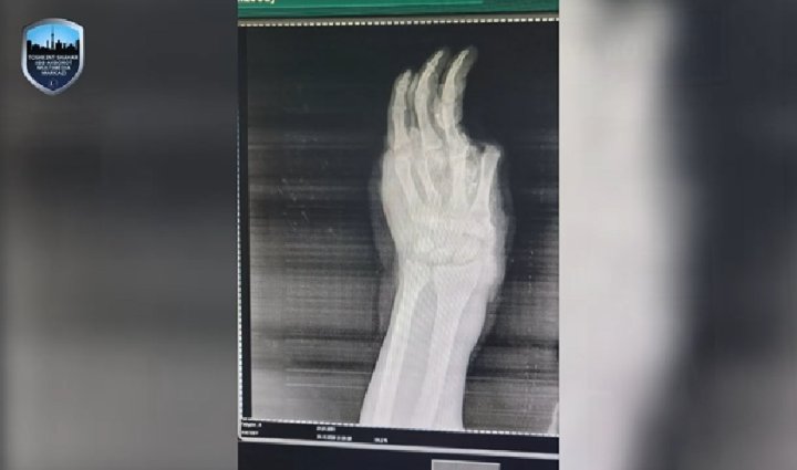 В Ташкенте ребёнок остался без кисти руки из-за пиротехники