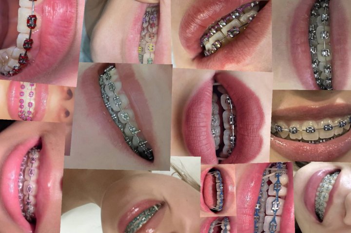 Ташкентцы в ужасе от цен на брекет-системы