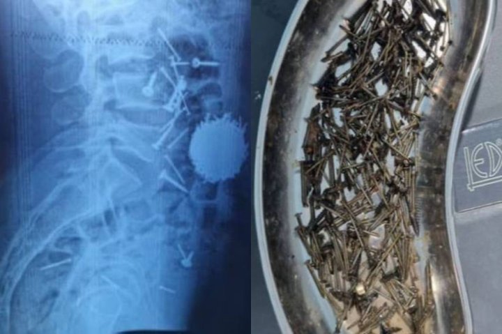 В Самарканде мужчина съел 200 граммов гвоздей и саморезов